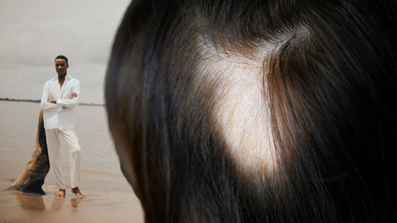 Hair Loss (Alopecia) in Horses – Signs, Causes & Treatment