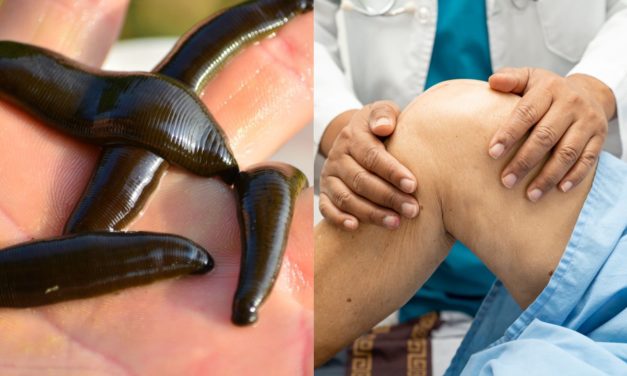 Amazing Benefit of Leech Therapy in Joint Pain.