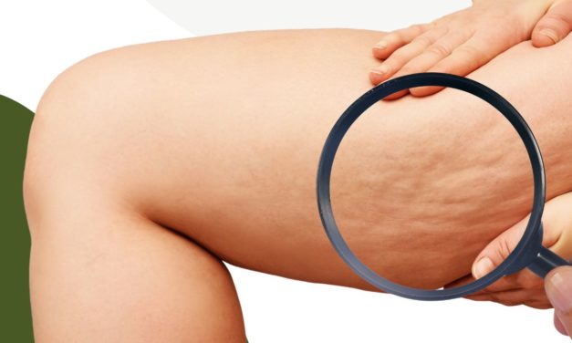 Cellulite Causes and Treatment