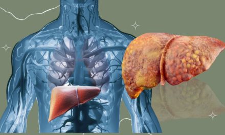 Cirrhosis Symptoms and Treatment