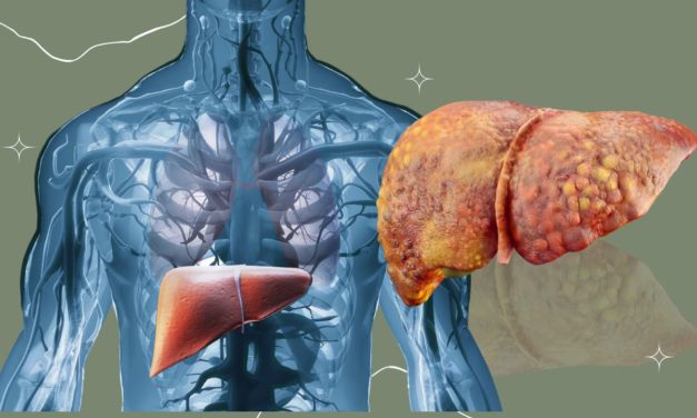 Cirrhosis Symptoms and Treatment