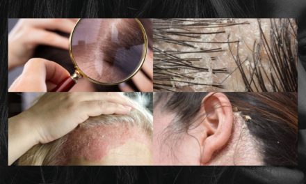 Dandruff: Let Us Tell You About Dandruff Disease and Treatment