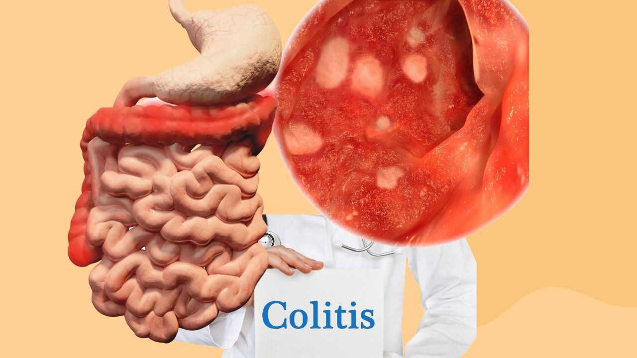 Understanding Colitis Symptoms and Treatment - HerbTib Blog