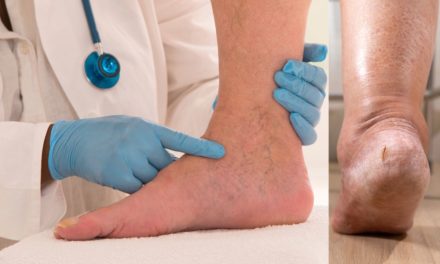 Oedema: Understanding the Causes of Edema