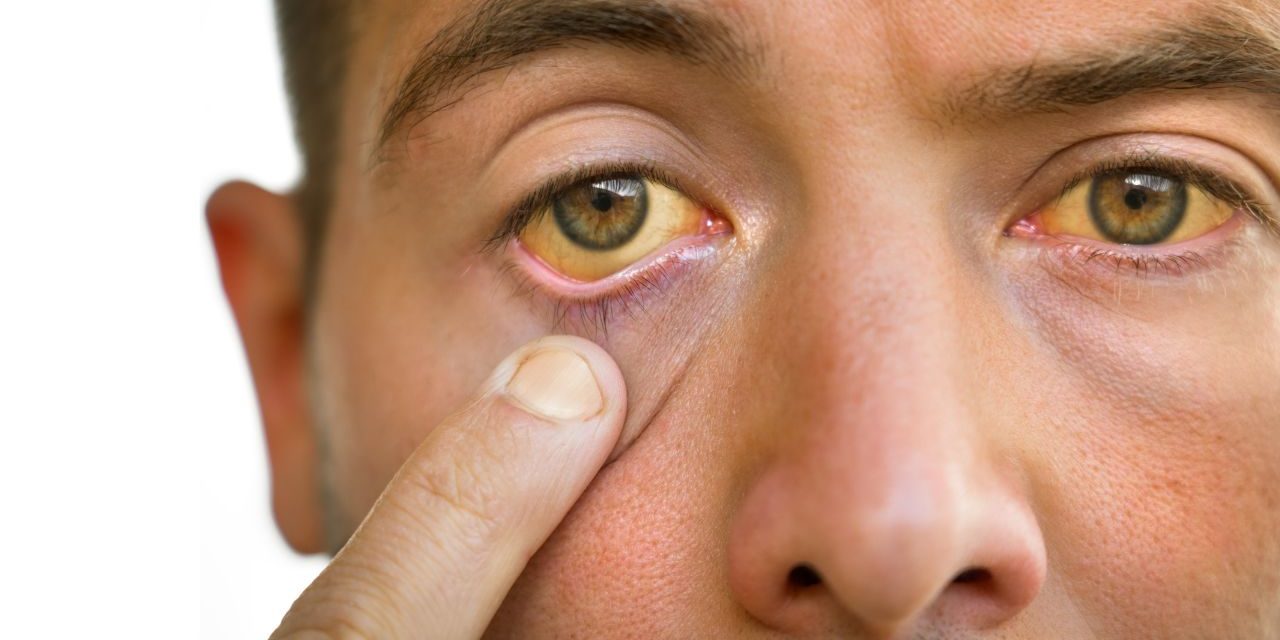 Jaundice: Understanding the Symptoms of Jaundice (Yellowing of the Skin and Eyes)