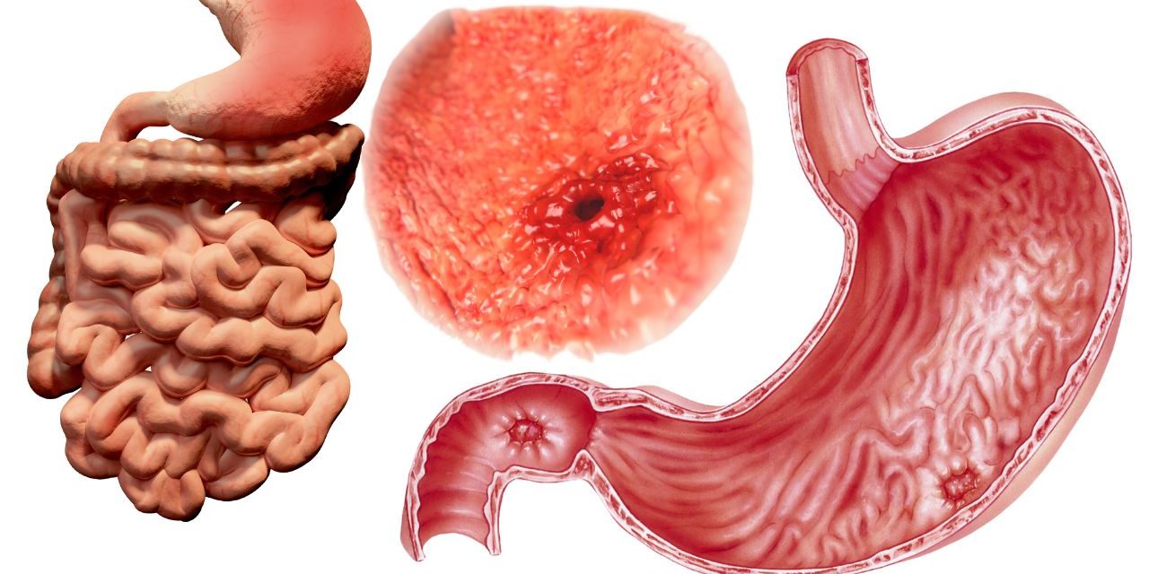 Ulcers: Understanding the Symptoms of Ulcers