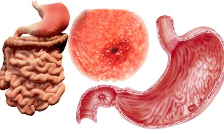 Ulcers: Understanding the Symptoms of Ulcers