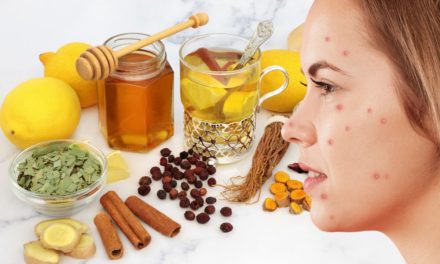 14 Tried and Tested Remedies for Dealing With Pimples