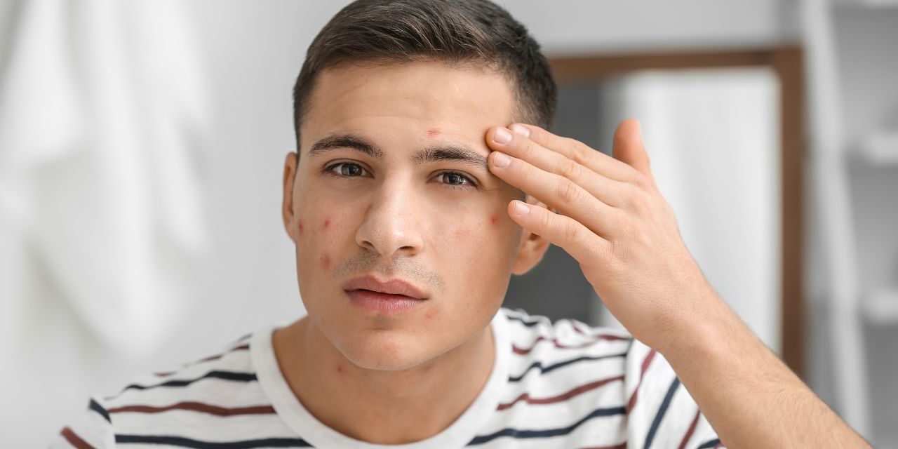5 COMMON CAUSES OF PIMPLE