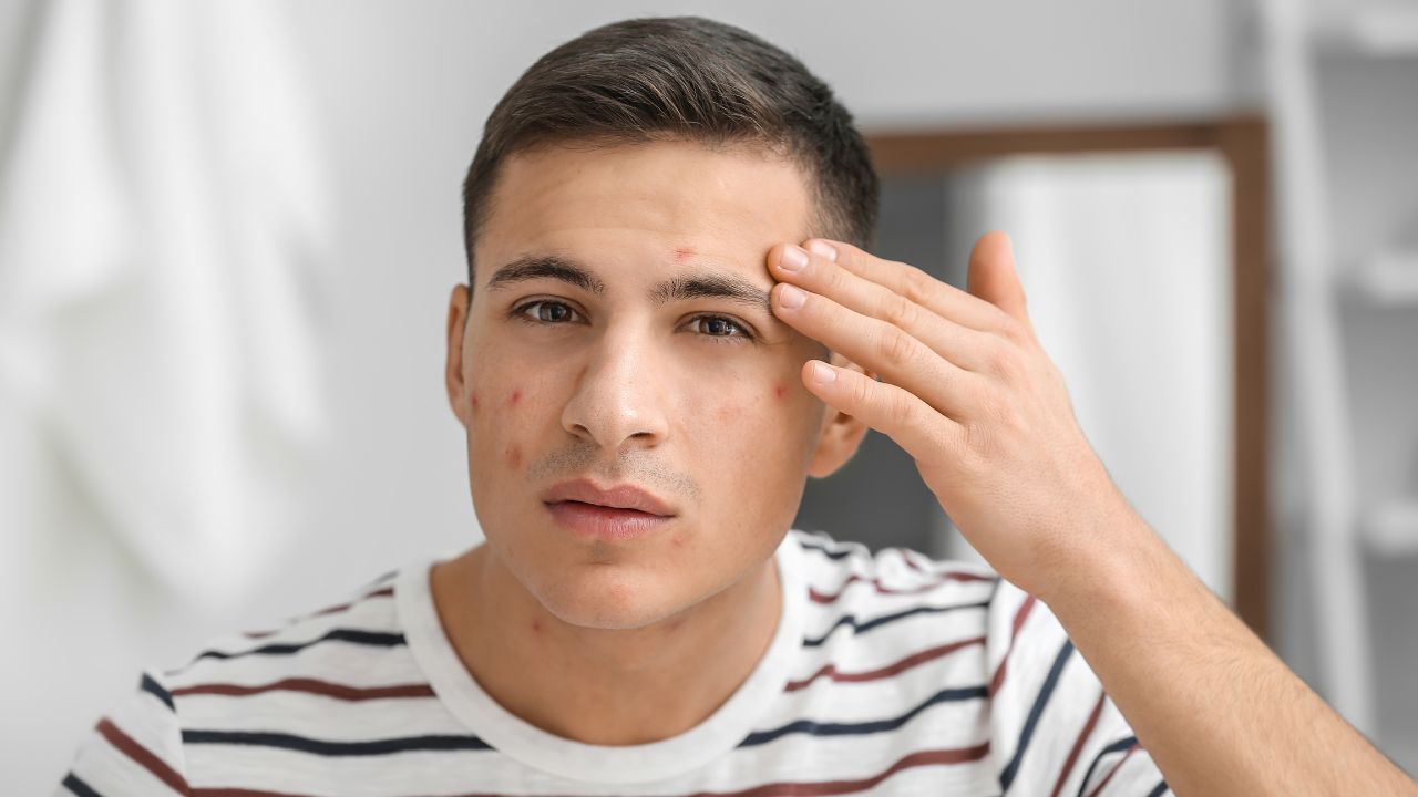 5 COMMON CAUSES OF PIMPLE - HerbTib Blog