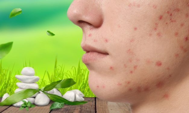 Acne Vulgaris Disease and Best Treatment