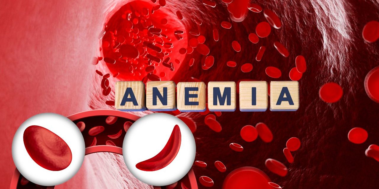 Anemia Disease And Best Treatment - Herbtib Blog