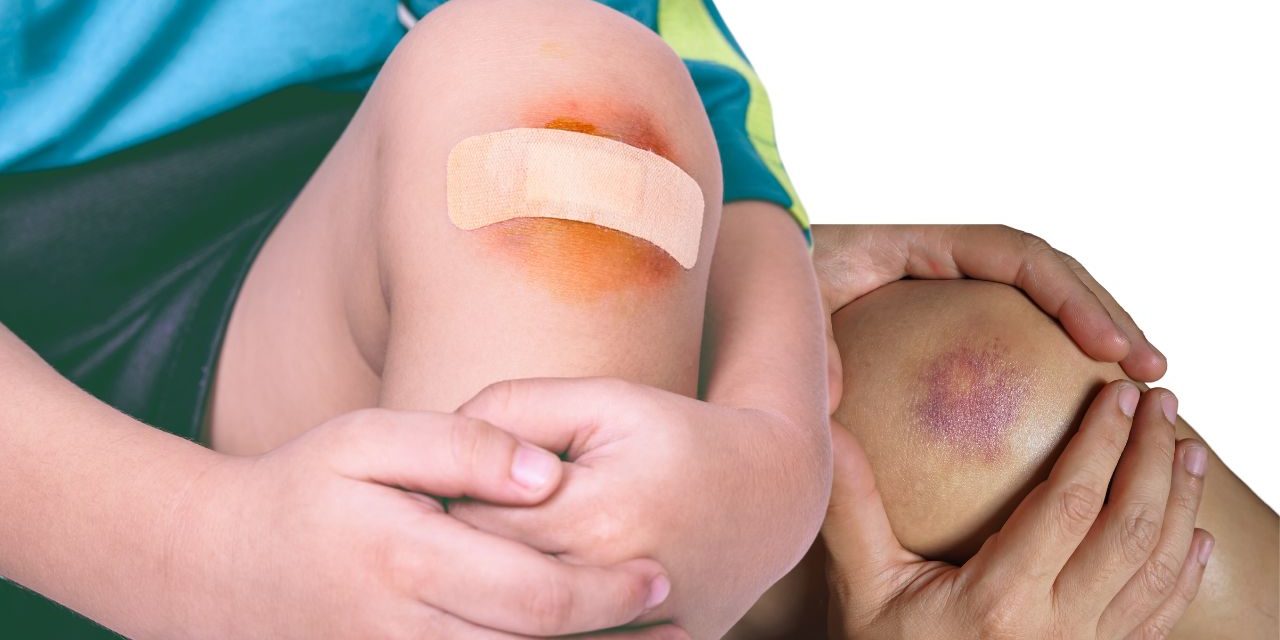 Bruises: Let Us Tell You About Bruises Disease and Treatment