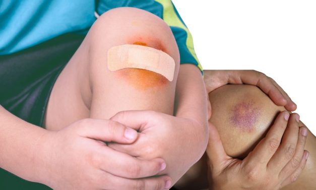 Bruises: Let Us Tell You About Bruises Disease and Treatment