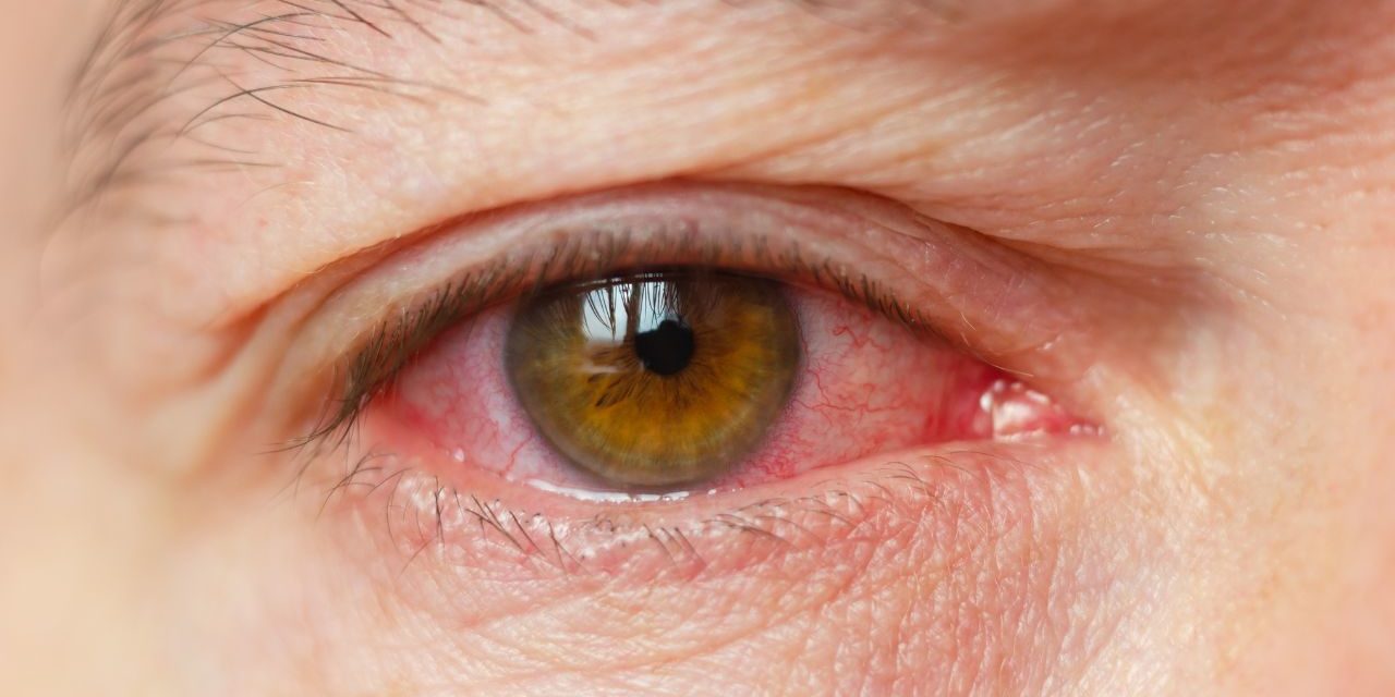 Conjunctivitis: Let Us Tell You About Conjunctivitis (Eye Flu)