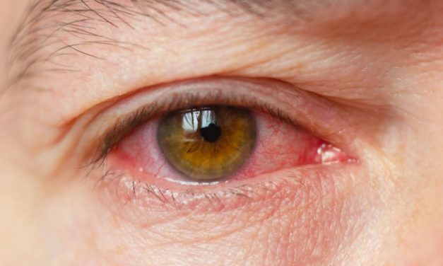 Conjunctivitis: Let Us Tell You About Conjunctivitis (Eye Flu)