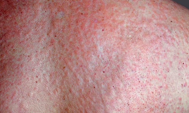 Heat Rash Disease and Best Treatment