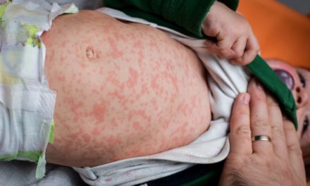 Measles Disease and Best Treatment