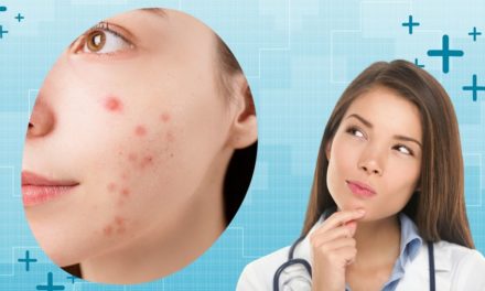 Getting to Know Pimple Myths And Misconception
