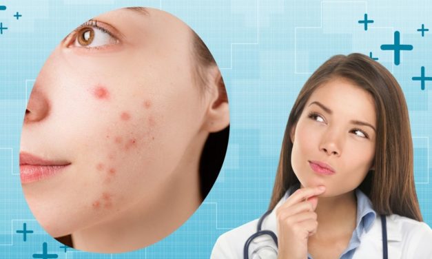 Getting to Know Pimple Myths And Misconception