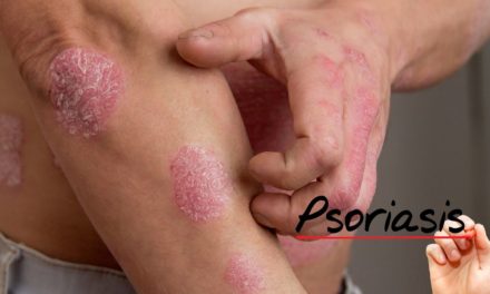 Psoriasis Disease and Best Treatment