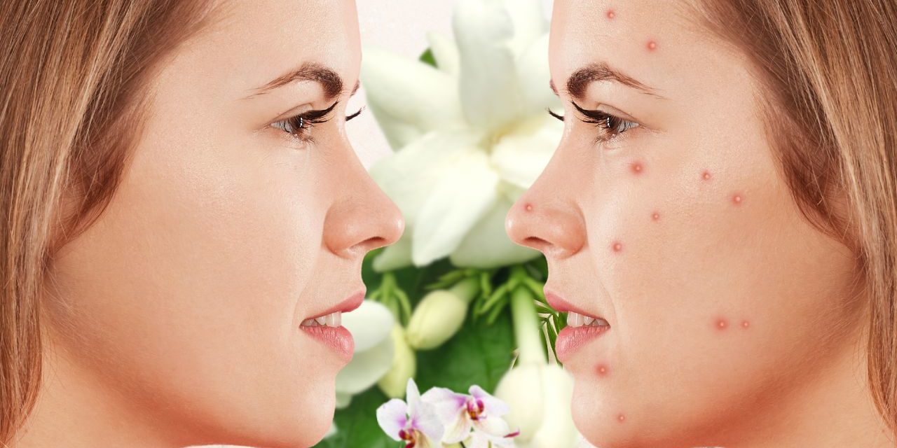 TRIED AND TESTED REMEDIES FOR CLEAR AND PIMPLE-FREE SKIN.