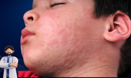 Urticaria Disease and Best Treatment