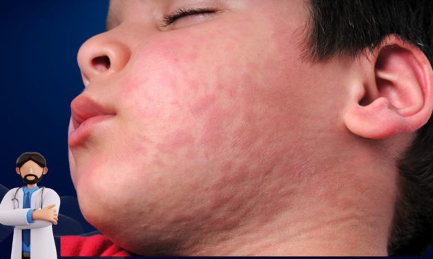 Urticaria Disease and Best Treatment