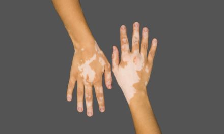 Vitiligo Disease and Best Treatment